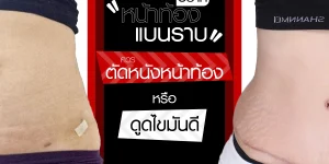 อยากหน้าท้องแบนราบ ควรตัดหนังหน้าท้องหรือดูดไขมันดี 1200px