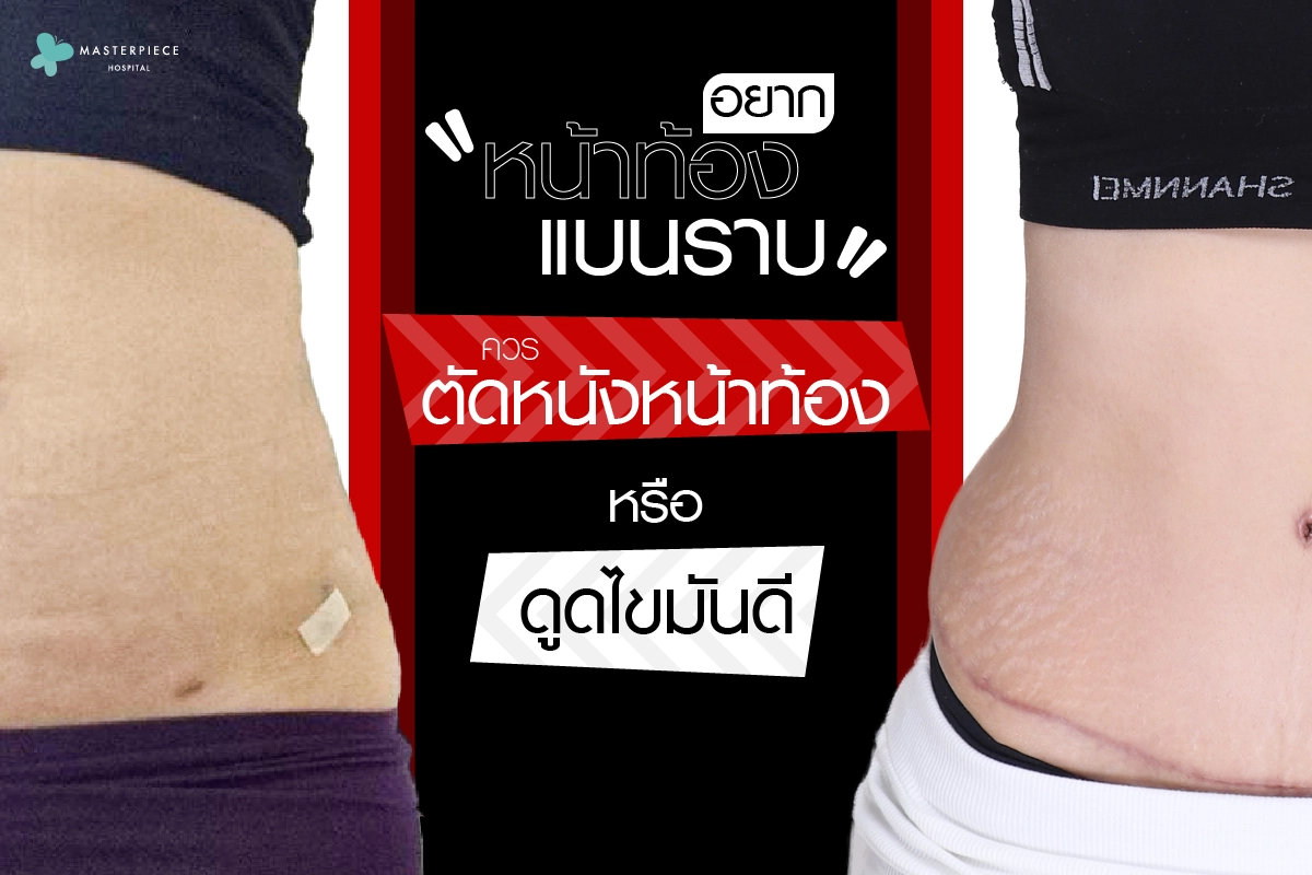 อยากหน้าท้องแบนราบ ควรตัดหนังหน้าท้องหรือดูดไขมันดี 1200px