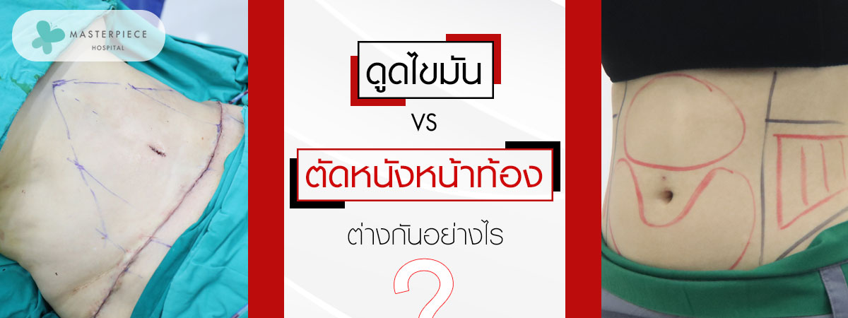 ดูดไขมัน VS ตัดหนังลดหน้าท้องต่างกันอย่างไร