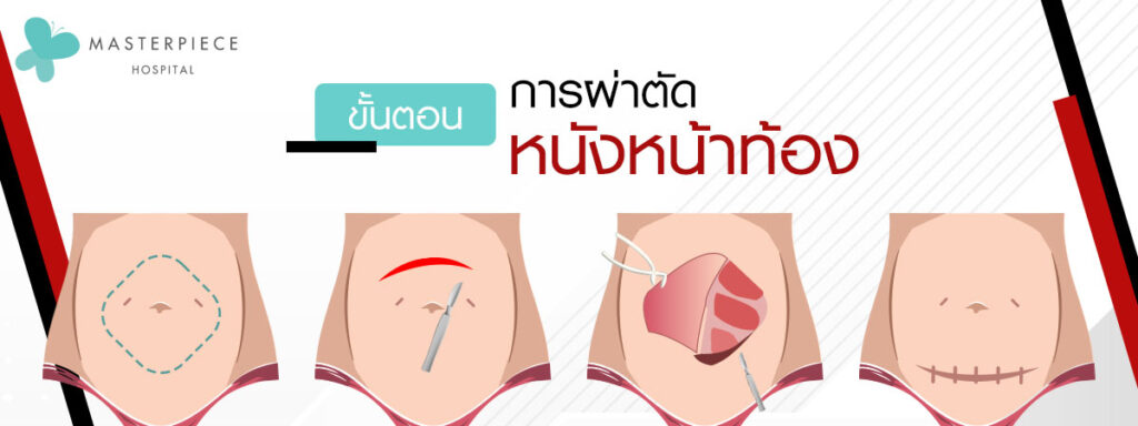 ขั้นตอนการผ่าตัดหนังหน้าท้อง