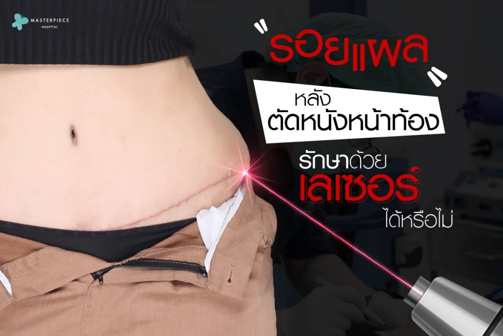 รอยแผลหลังตัดหนังหน้าท้องรักษาด้วยเลเซอร์ได้หรือไม่