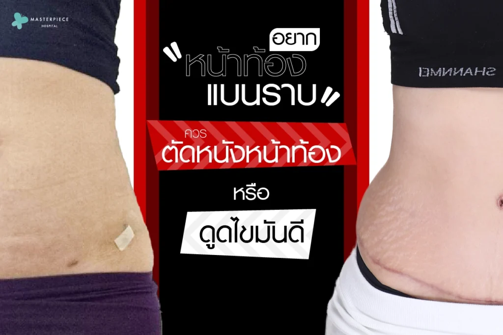 อยากหน้าท้องแบนราบ-ควรตัดหนังหน้าท้องหรือดูดไขมันดี